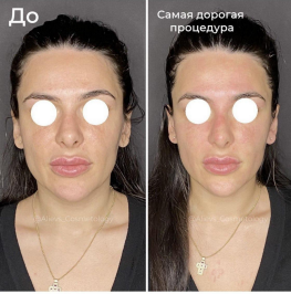 RF-лифтинг лица Thermage