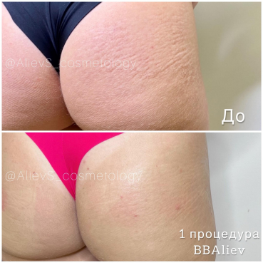 BBAliev (процедура по устранению растяжек)